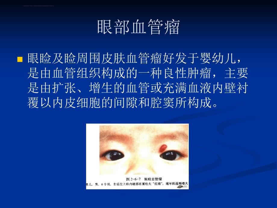 儿童常见眼部肿瘤1课件_第2页