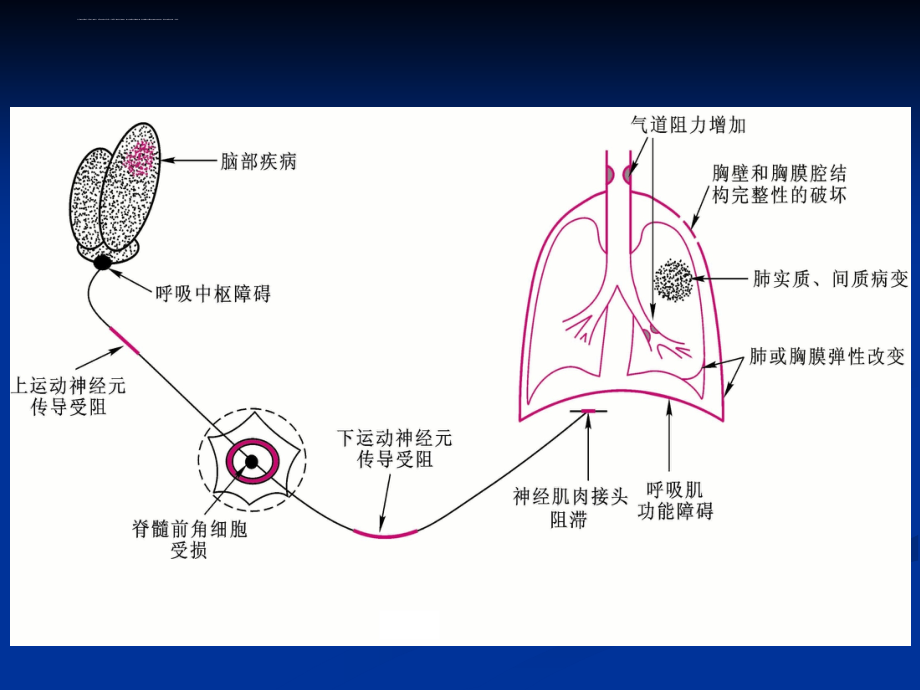 呼吸衰竭赵明护理学课件_第3页