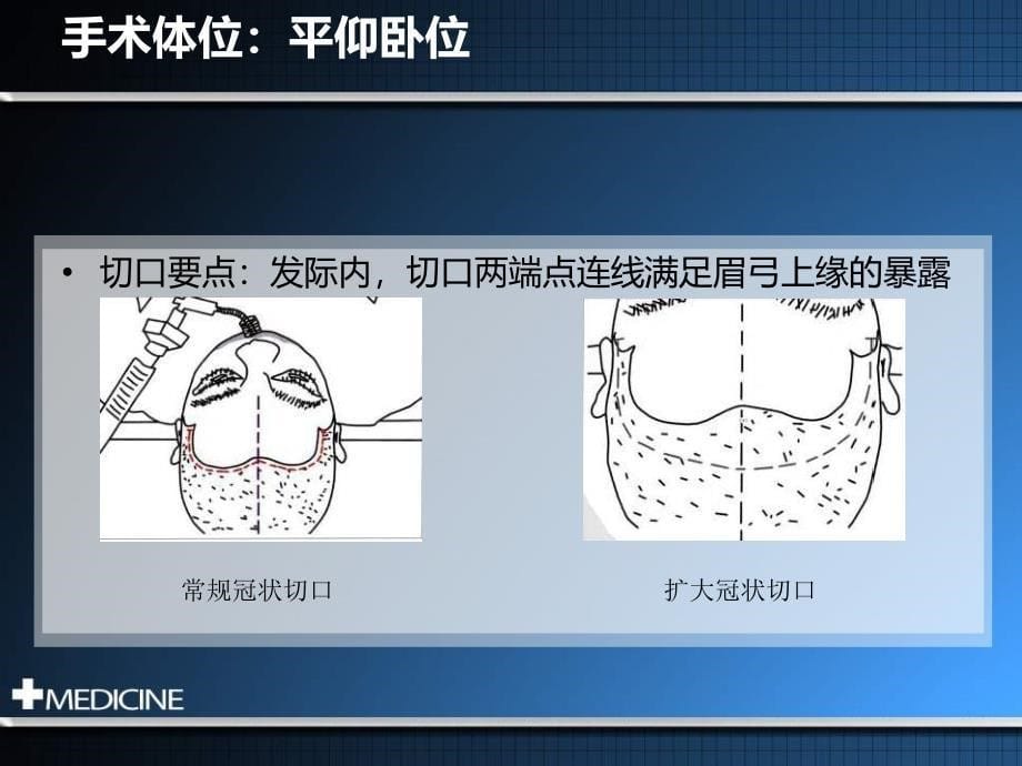 冠切开颅额下入路_第5页