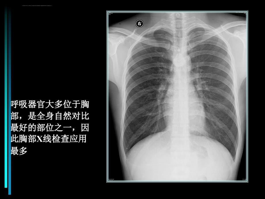 呼吸系统正常x线诊断学课件_第5页
