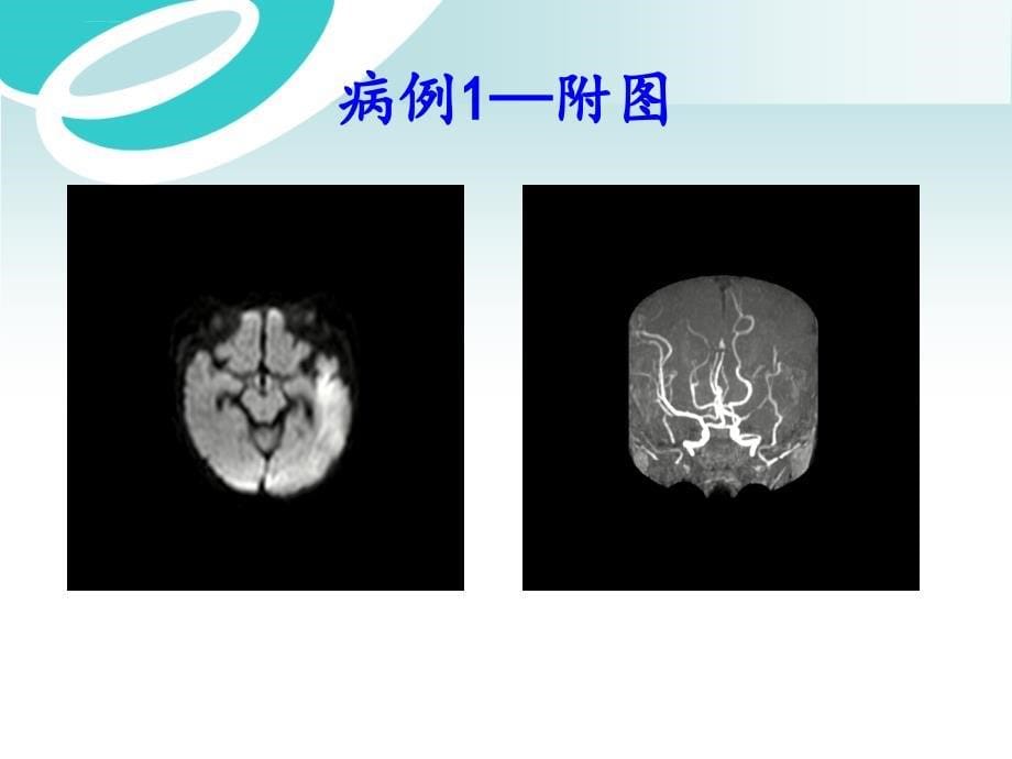 中枢神经系统感染白色念珠菌病--病例分享课件_第5页