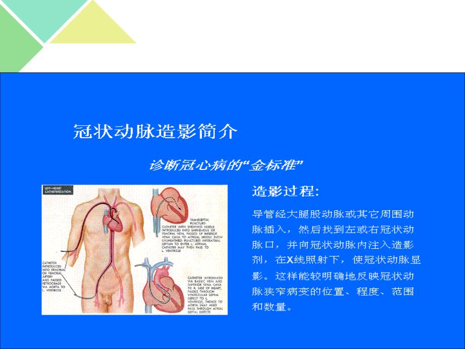 上传-心脏介入治疗的简介课件_第3页