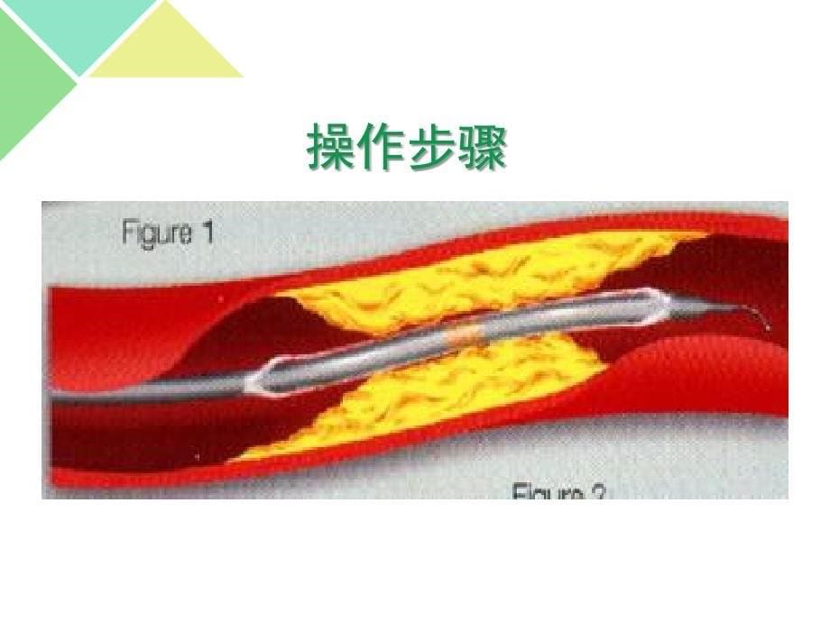 上传-心脏介入治疗的简介课件_第5页