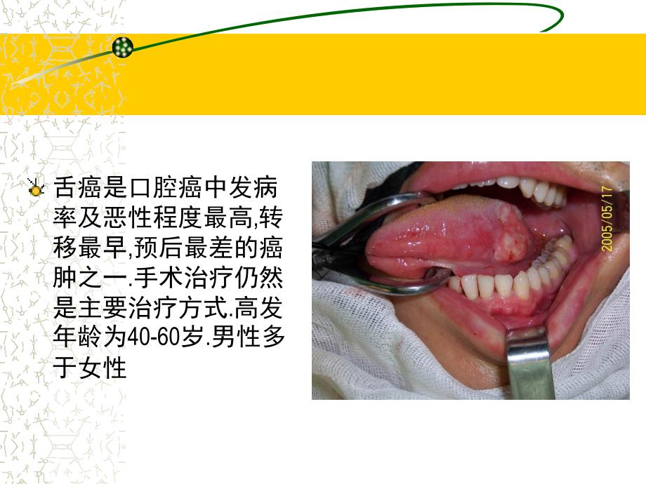 常见三种舌癌手术方式1_第3页