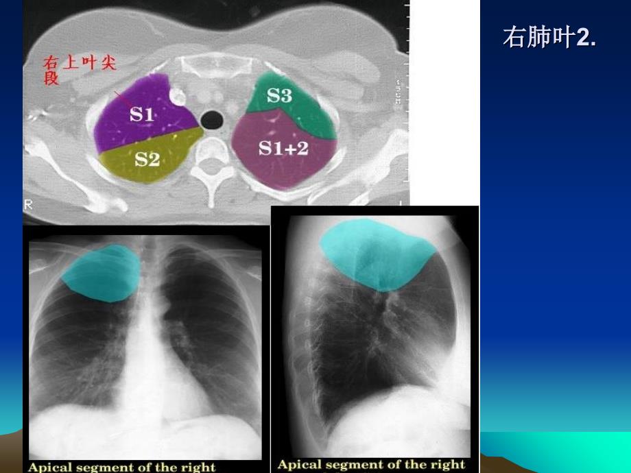 ct正常彩色解剖图-肺段课件_第3页