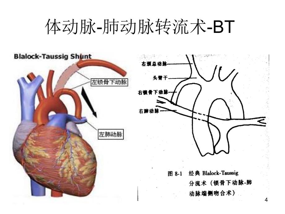 体动脉-肺动脉转流术之术后监护要点_第4页