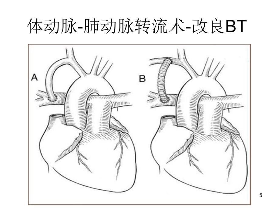 体动脉-肺动脉转流术之术后监护要点_第5页