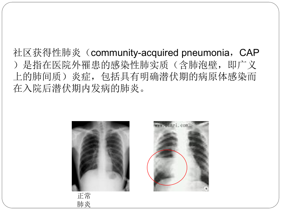 肺炎培训PPT：社区获得性肺炎的诊断与治疗_第2页