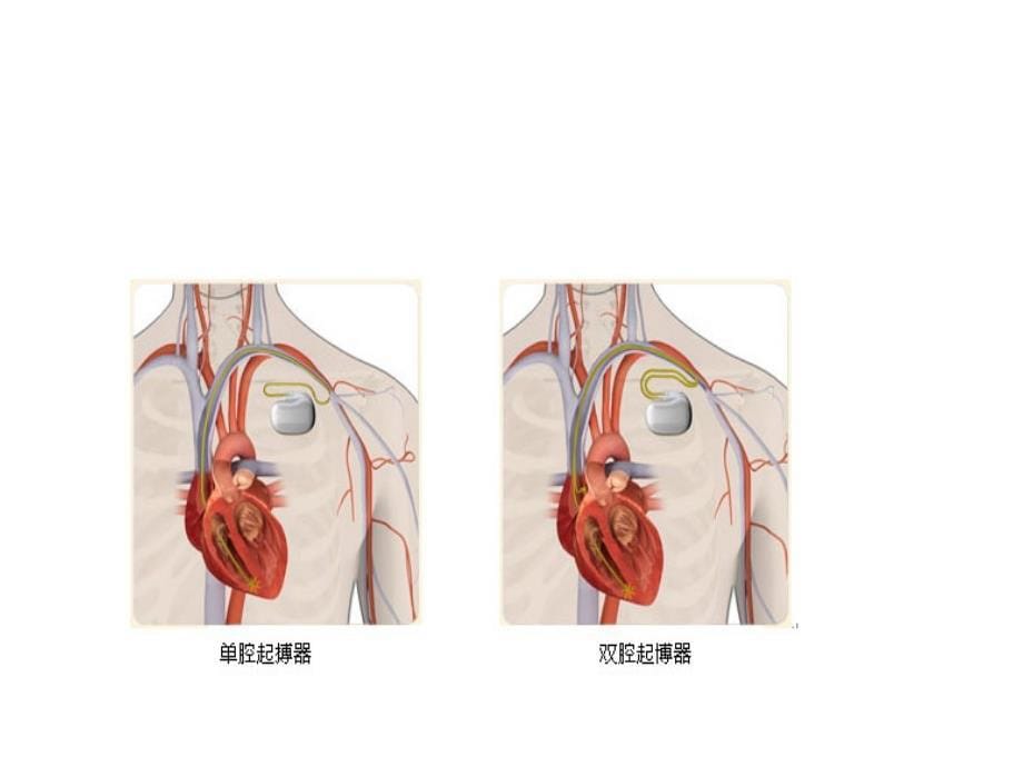 心脏起搏器治疗及_第5页