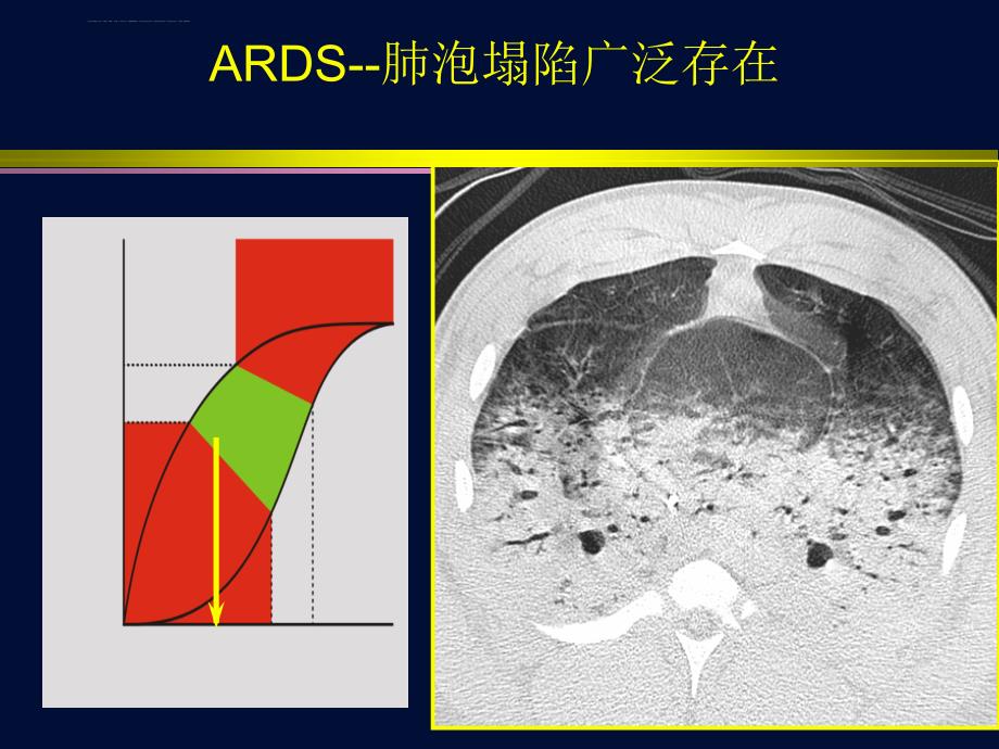 ards-柏林定义对临床改变了什么？课件_第4页