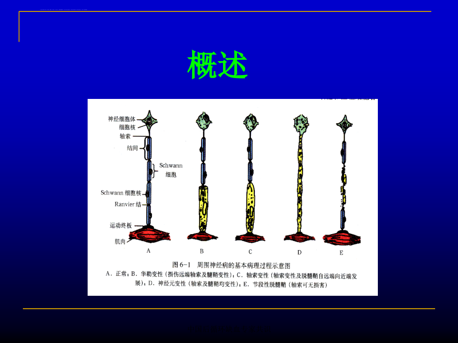 周围神经疾病-(3)课件_第3页