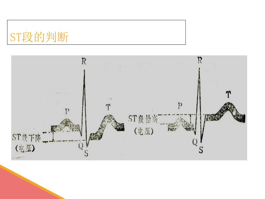 心电图基础知识1课件_第4页