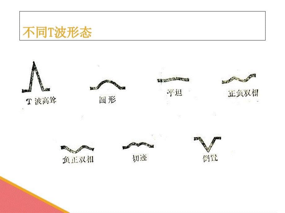 心电图基础知识1课件_第5页