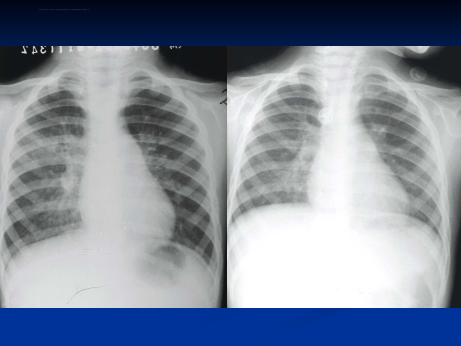 医学影像诊断学-呼吸系统4课件_第2页