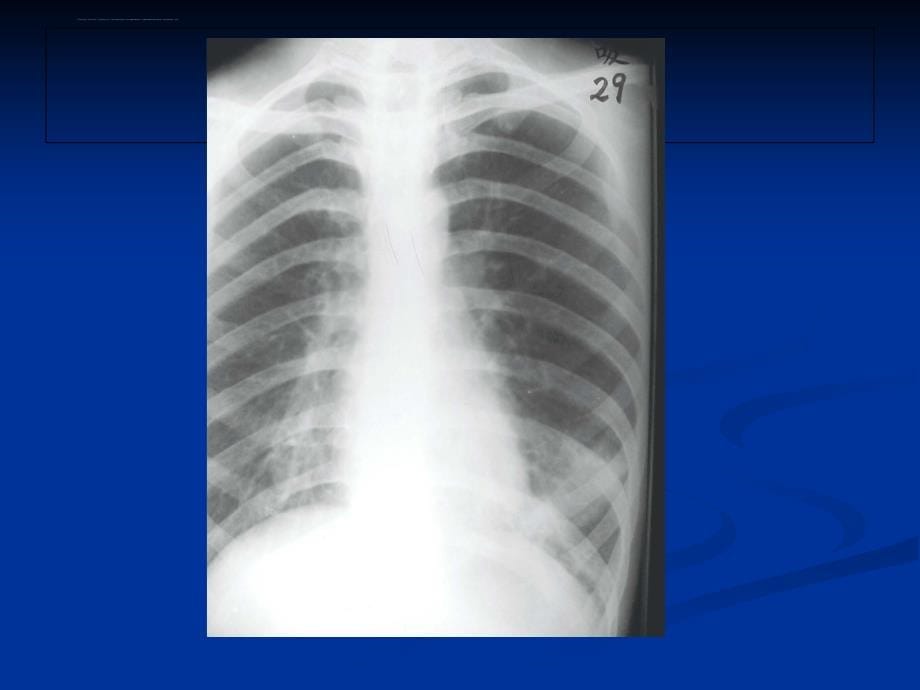 医学影像诊断学-呼吸系统4课件_第5页
