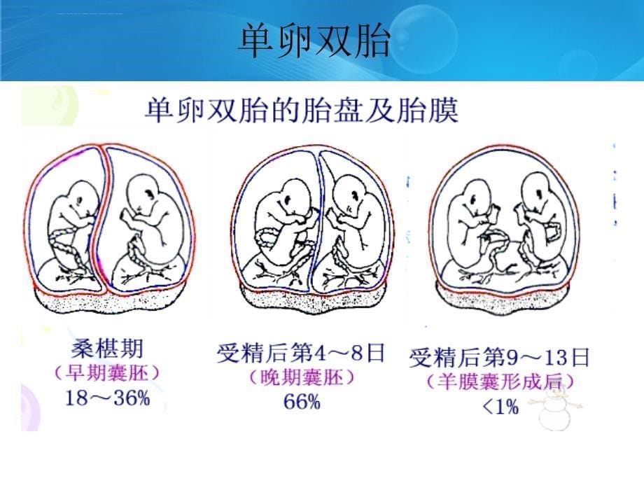 双胎妊娠特有并发症课件_第5页