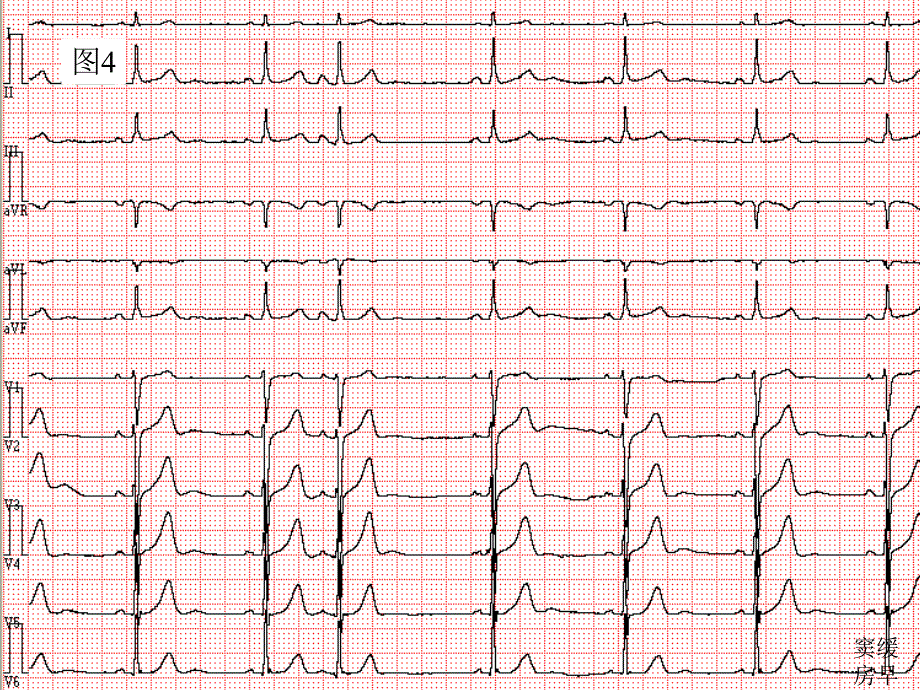 2007级专科医生培训心电图年度考核题课件_第4页