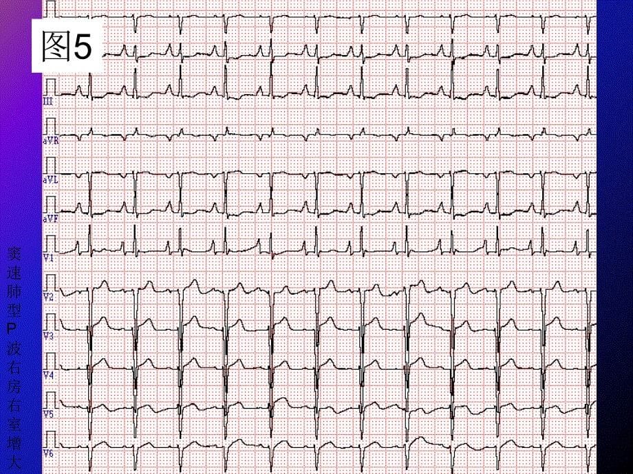 2007级专科医生培训心电图年度考核题课件_第5页