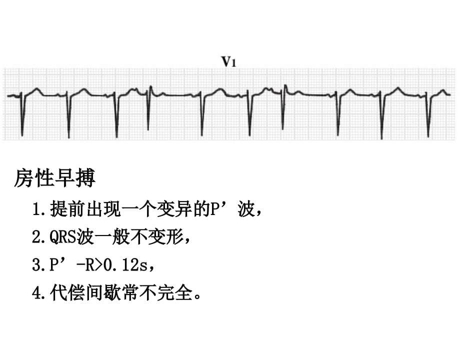 心脏扑动、颤动和传导阻滞心电图-(2)课件_第5页