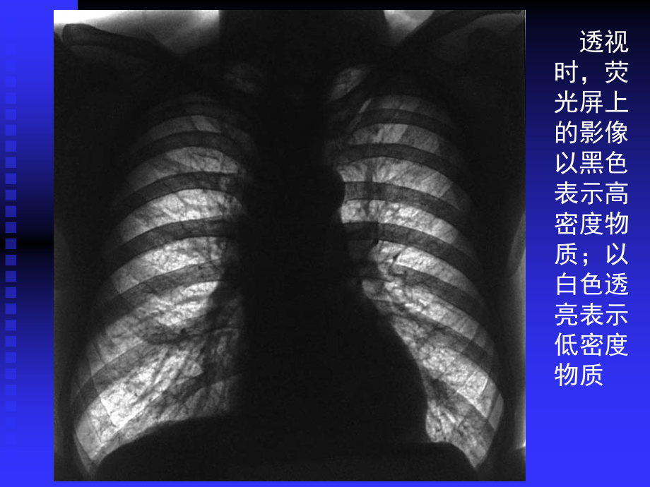 复旦肿瘤医院胸部影像学课件_第3页