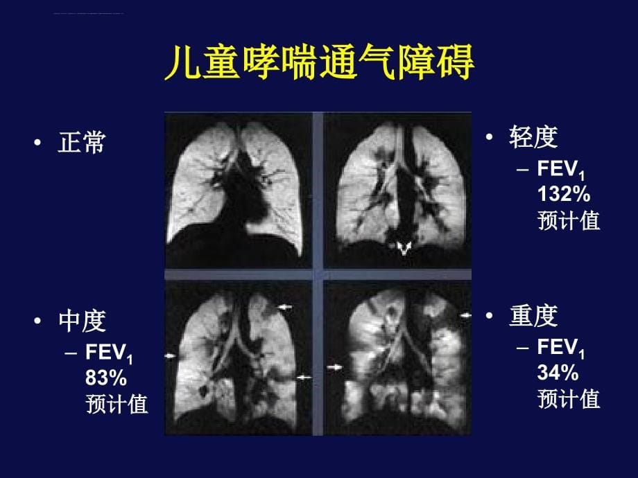 上海交通大学医学院-新华-儿童-儿童医学中心-儿科学-之-哮喘进展-儿科哮喘管理的新模式课件_第5页