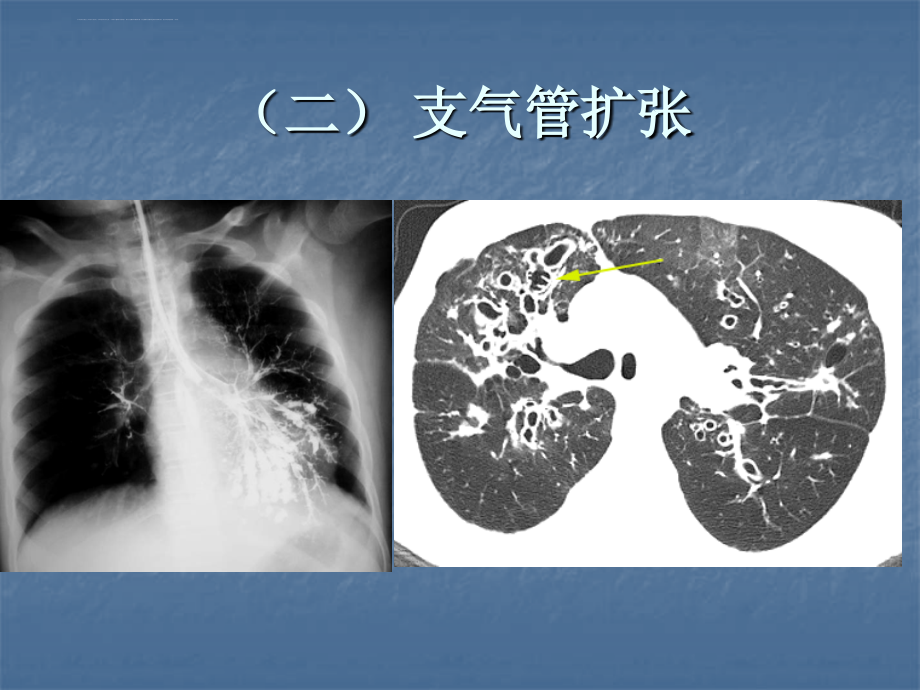 年制影像诊断学呼吸系统2012年（2）课件_第4页