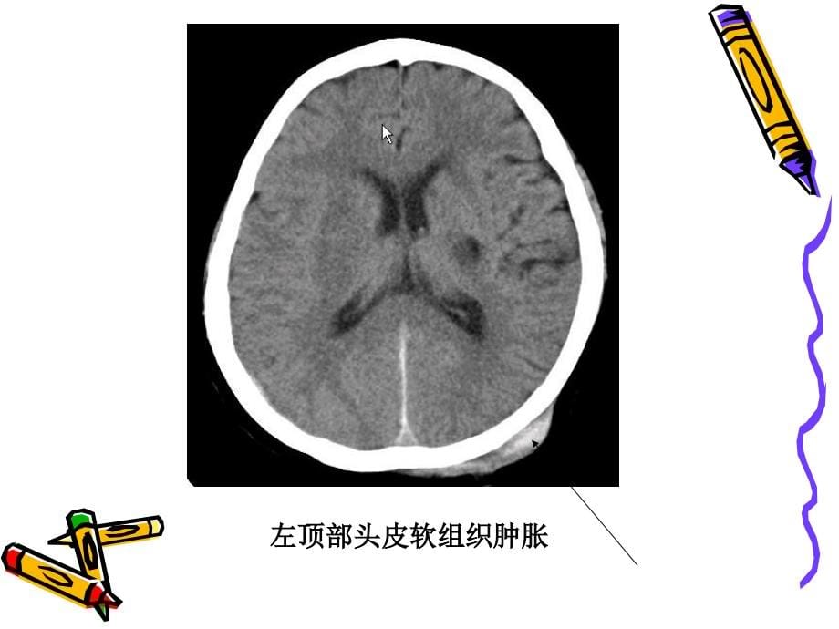 解很好颅脑ct诊断_第5页