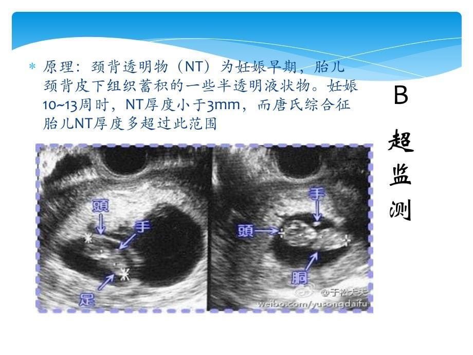 三体综合征产前诊断课件_第5页