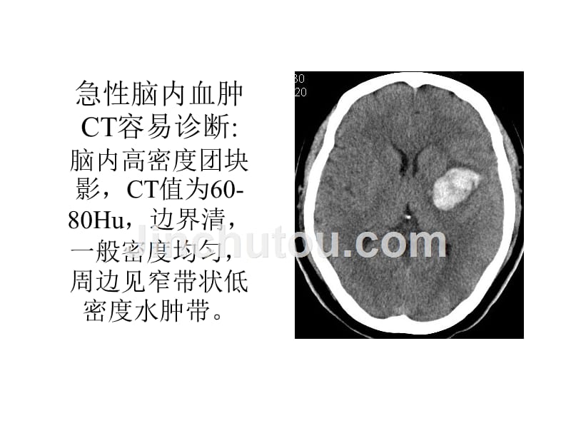 急性脑血管病ct征象分析课件_第4页