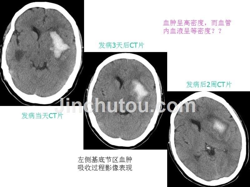 急性脑血管病ct征象分析课件_第5页