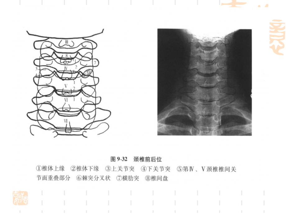 颈椎x线阅片课件_第4页