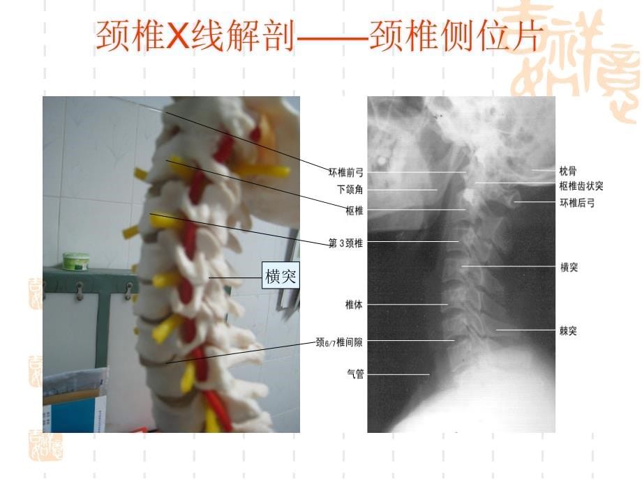 颈椎x线阅片课件_第5页