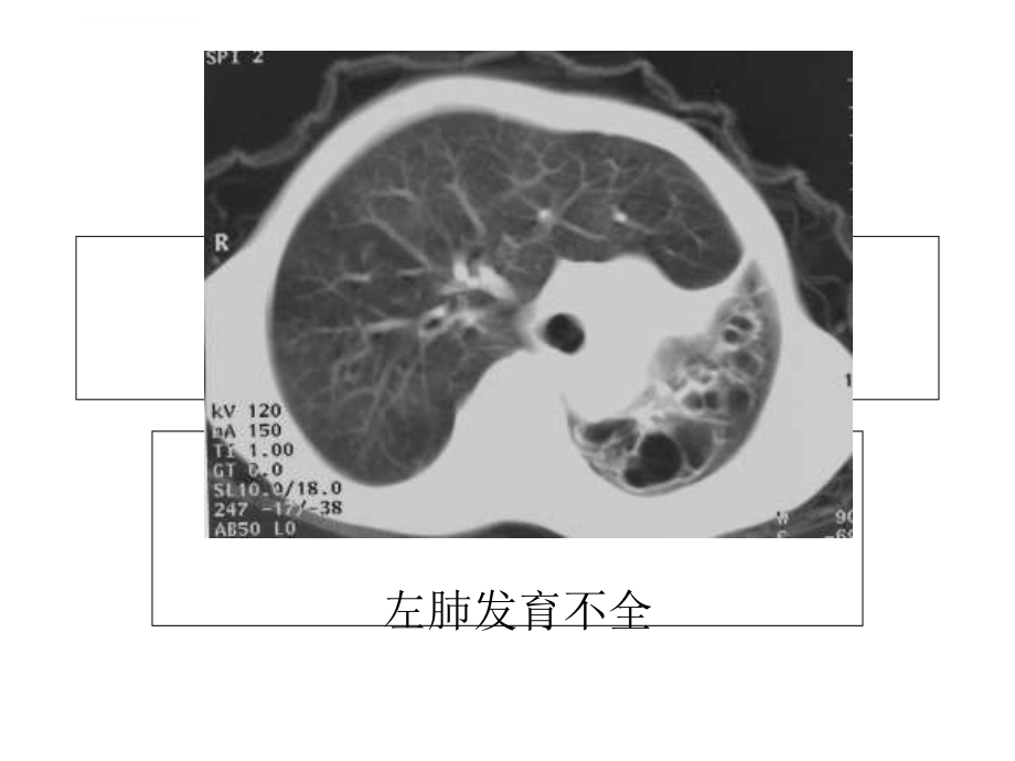 南医学影像精品课程之肺部炎症课件_第3页