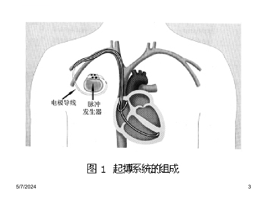 丁主任-人工心脏起搏器与麻醉(简版)课件_第3页