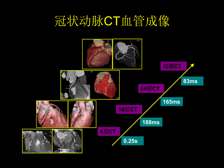 多排螺旋ct在冠状动脉成像中的应用_第3页