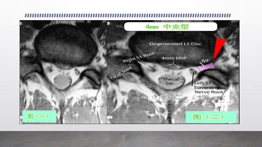 腰椎间盘突出影像_第3页