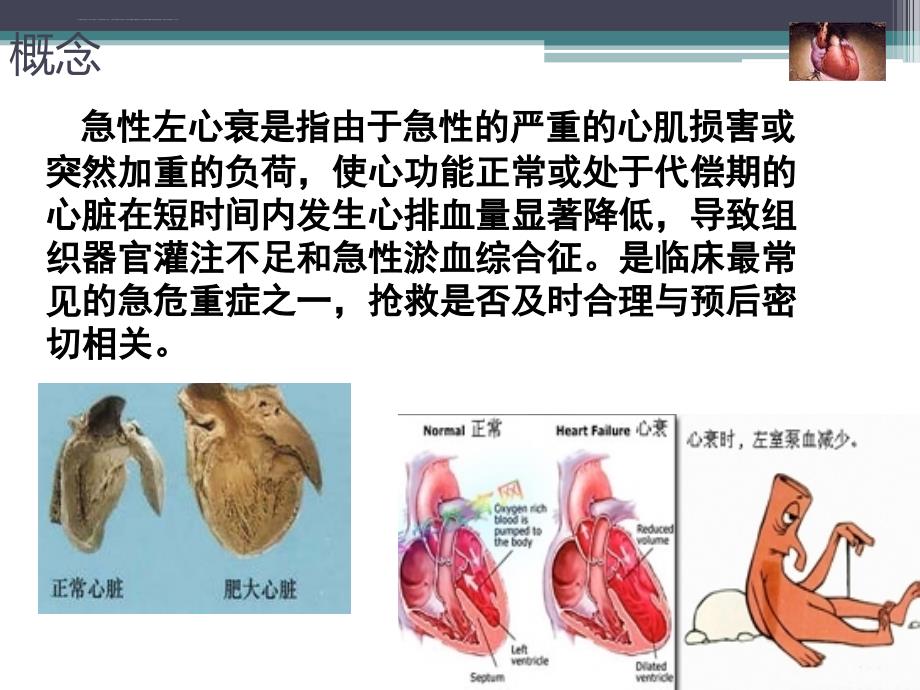 左心衰的急救护理课件_第4页