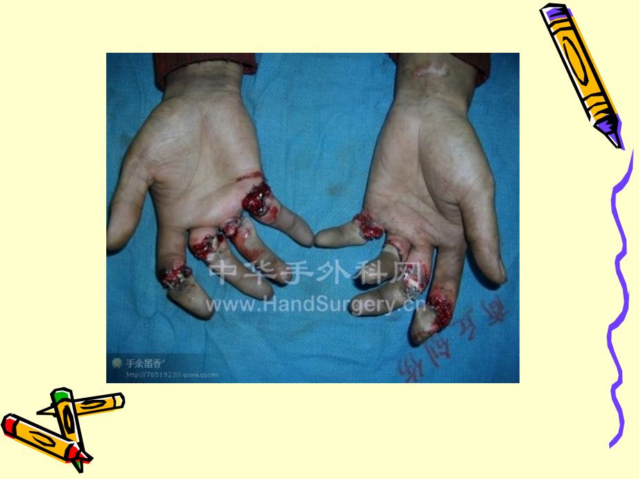 断指趾再植患者的护理课件_第3页