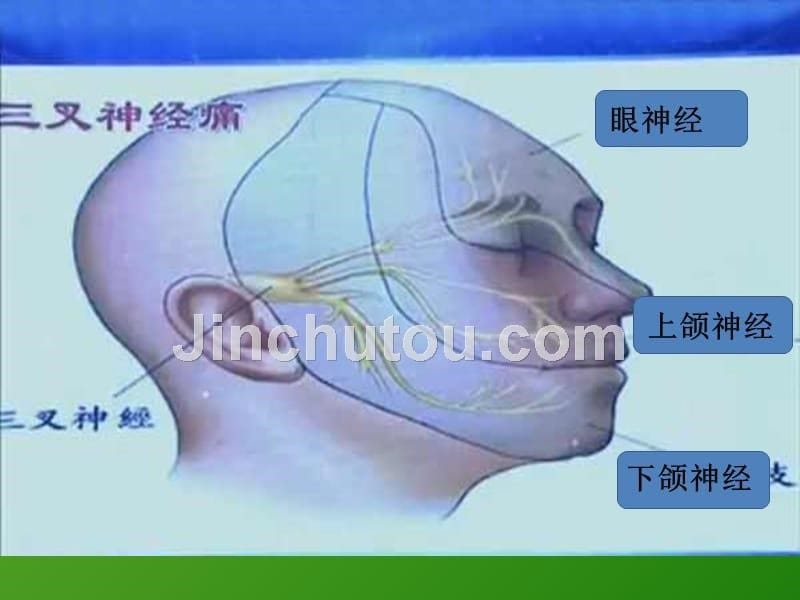 三叉神经定位及诊断课件_第5页