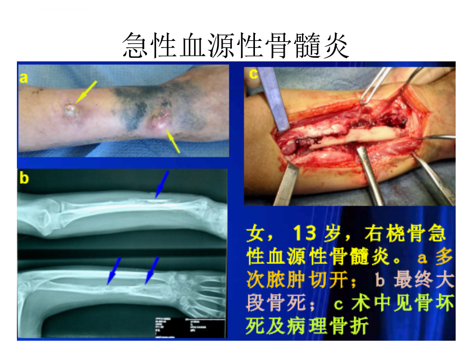 化脓性感染课件_第3页