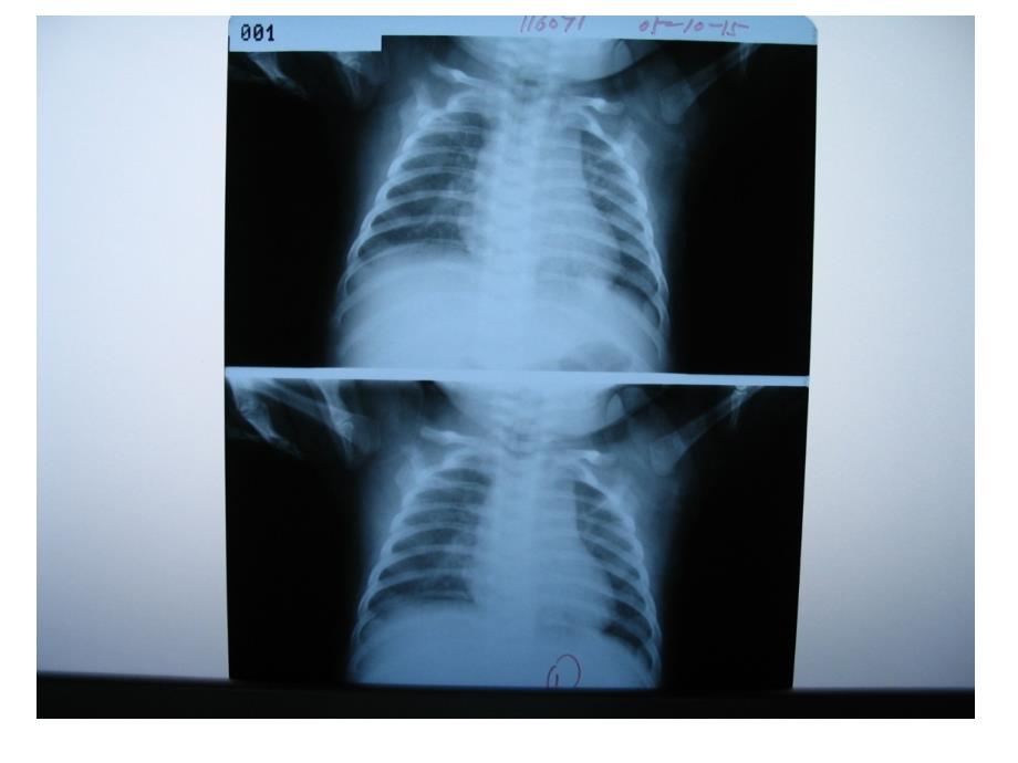 儿科呼吸系统-毛细支气管炎课件_第2页