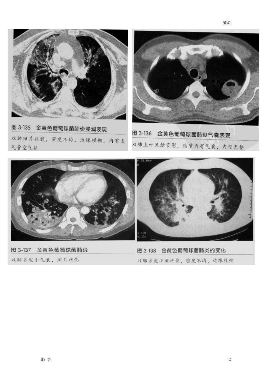 肺炎材料：金黄色葡萄球菌肺炎CT征象_第2页