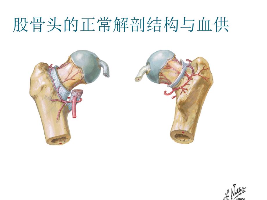 股骨头坏死-巡诊课件_第3页