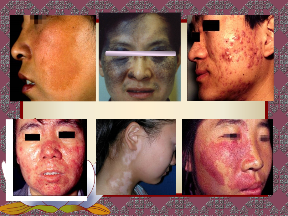 常见损容性皮肤病的治疗与美容西安交通大学第二医院皮肤科曾维惠_第4页