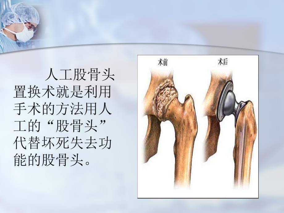 股骨头置换术围手术期护理课件_第2页