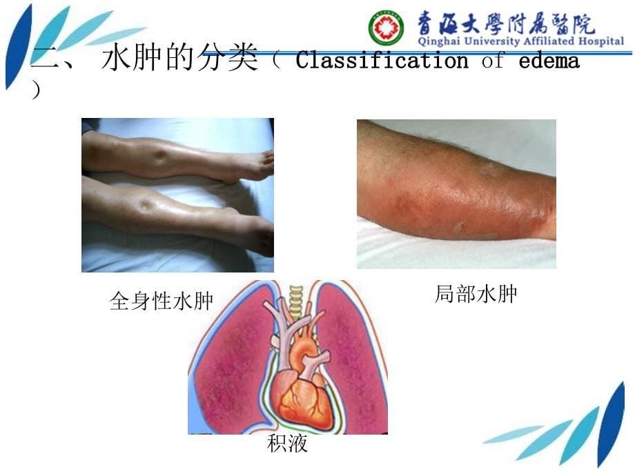 诊断学--水肿课件_第5页