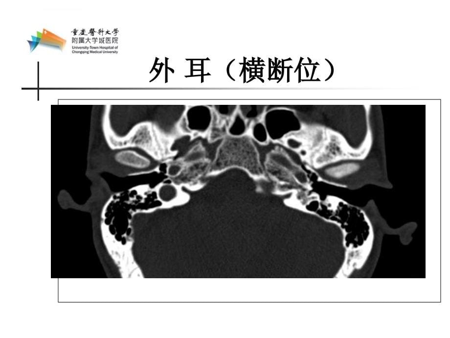 耳部ct解剖(大学城医院)课件_第5页