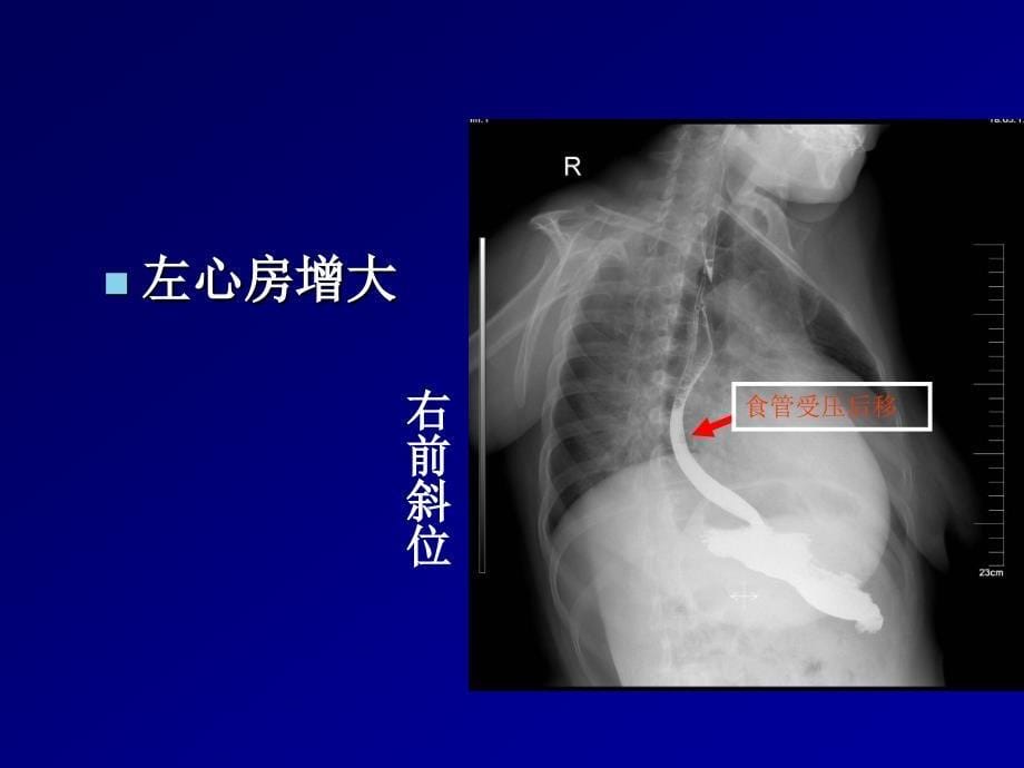 循环系统常见疾病x线表现_第5页