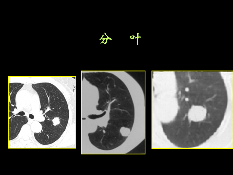 肺部常见病征象分析课件_第4页