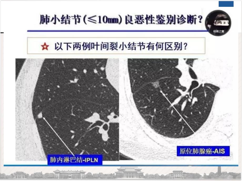 肺内淋巴结的ct表现与鉴别诊断课件_第2页